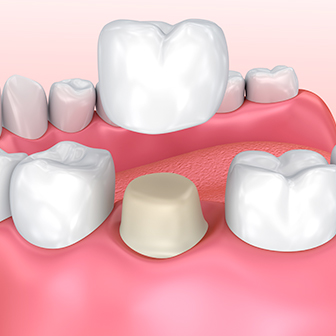 dental crown diagram