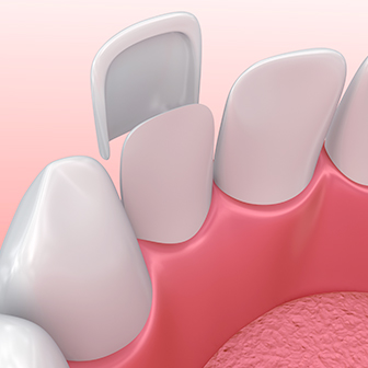 porcelain veneer diagram