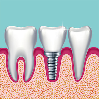 Illustration of dental implant