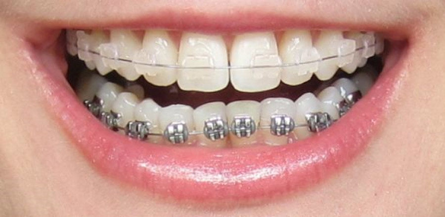 smile showing metal and ceramic braces