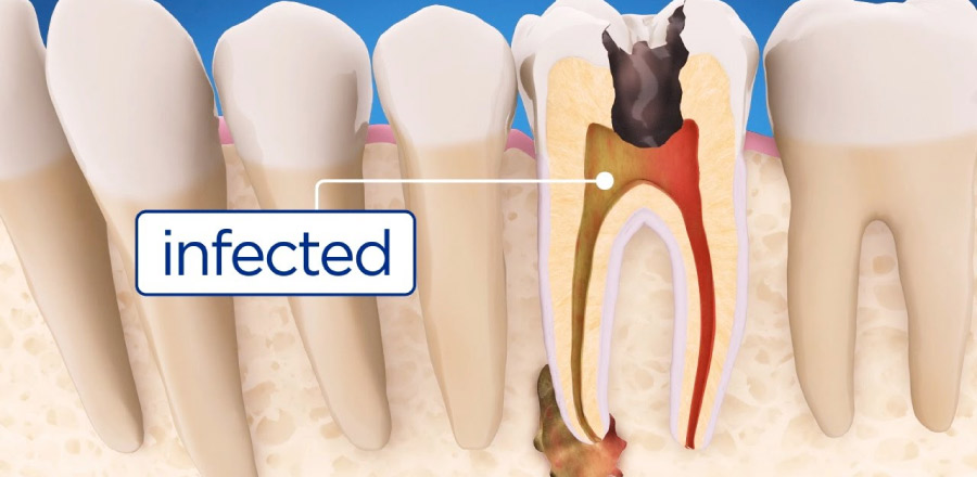 illustration of what root canal infection looks like